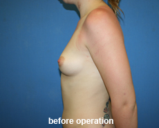 plastic-surgery-breast-augmentation